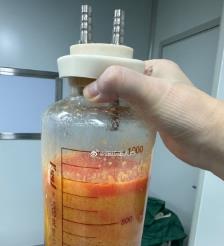 乌兰察布水动力吸脂手术要做多久？